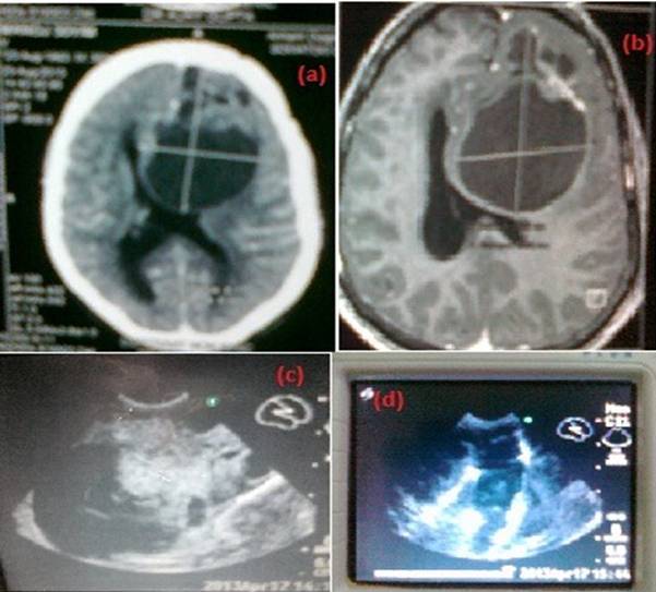 Fig 2.  A 28 years old male with left frontal glioma (a large cyst with small solid component) (a). preoperative CT scan, (b). MRI Axial, (c).Intraoperative ultrasound, (d).Intraoperative ultrasound postexcision