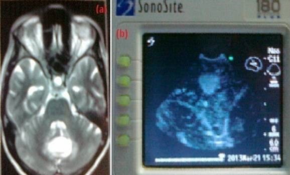Fig.3.Vermian metastatic adenocarcinoma (a).T2 MRI image, (b). Intraoperative Ultrasound